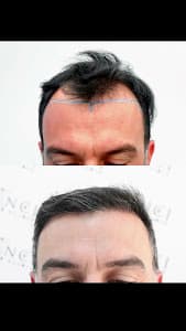 Vinci Hair Clinic Vila Olímpia | Transplante Capilar em São Paulo - foto 3